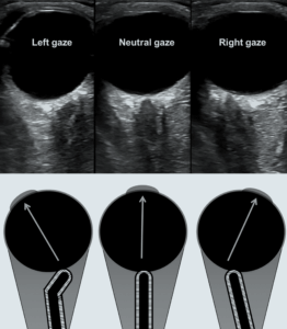 A image from the paper: Ultrasonographic Optic Nerve Sheath Diameter Technical Pitfalls and Imaging Artifacts