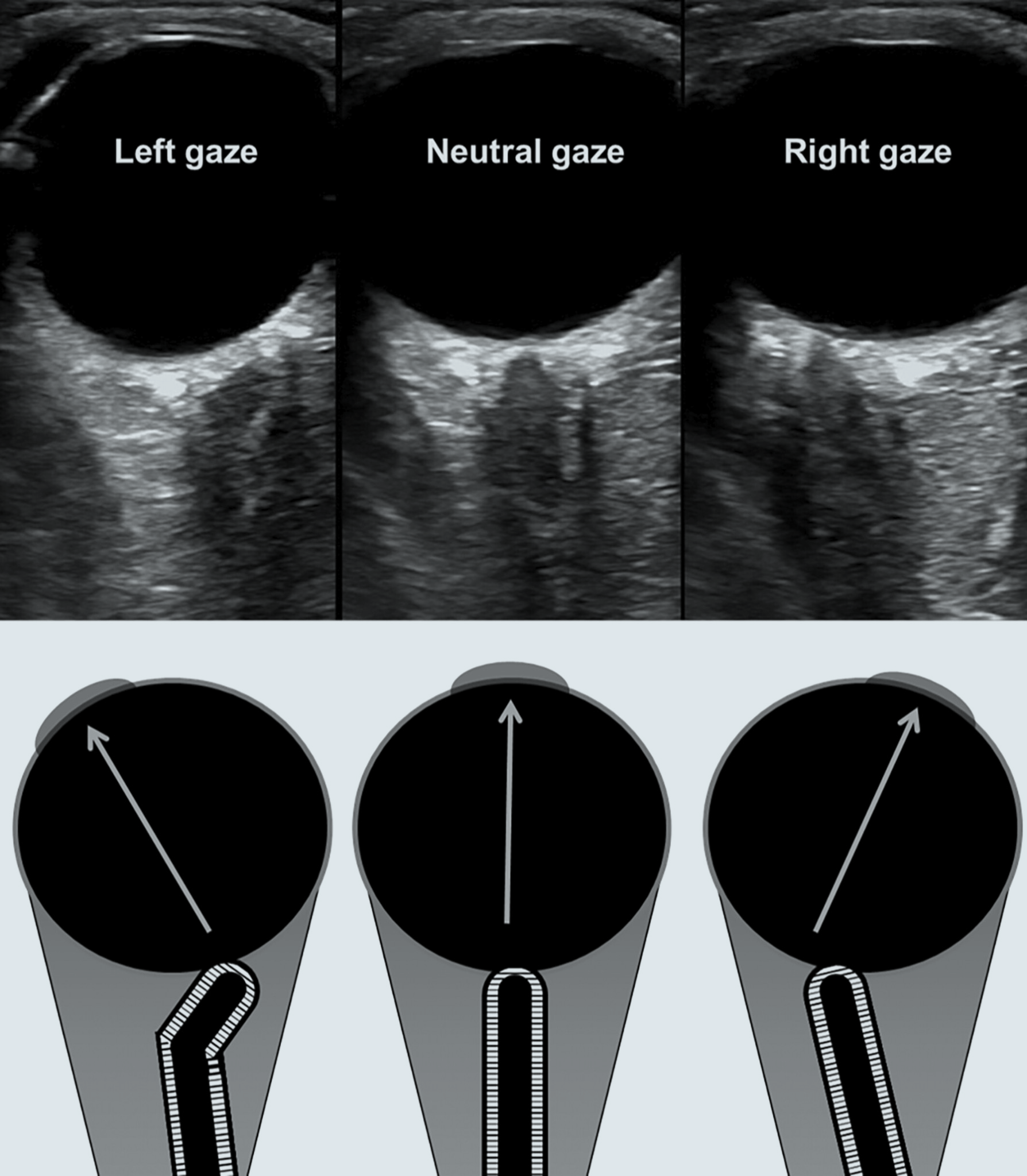 A image from the paper: Ultrasonographic Optic Nerve Sheath Diameter Technical Pitfalls and Imaging Artifacts