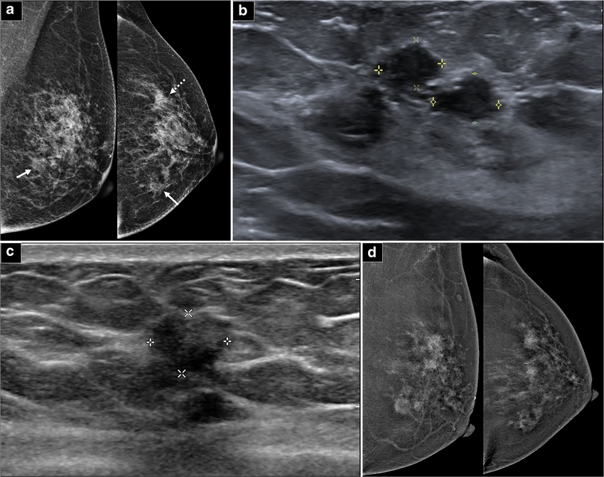 Unveiling MammoDINO: an anatomically aware vision foundation model for mammography