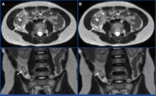Deep learning reconstruction improves appendix visualization on pediatric magnetic resonance imaging (MRI): a single-center experience
