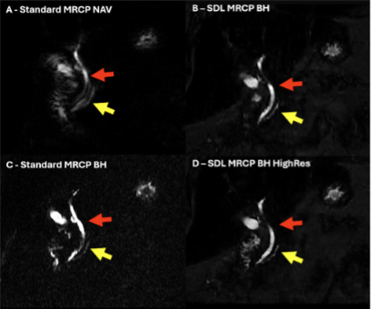 Clinical evaluation of deep learning accelerated 3D magnetic resonance cholangiopancreatography at 1.5 T and 3 T